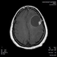 Beyindeki Tümör Görüntüsü